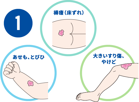 1褥瘡（床ずれ）あせも、とびひ大きいすり傷、やけど